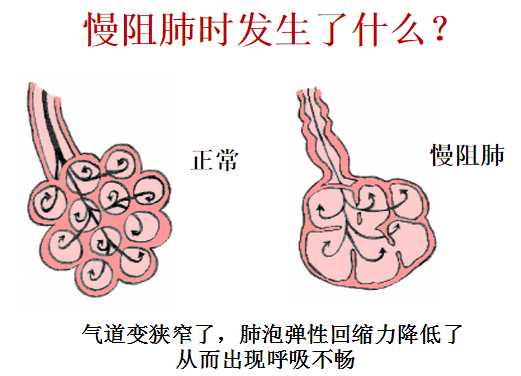 逆转慢阻肺最新技术，重塑呼吸自由的希望之光